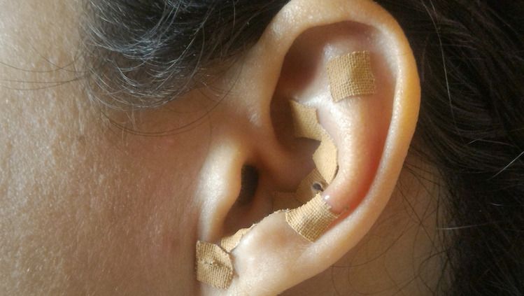 Does At-Home Ear Seed Acupuncture Work?